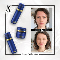 Clarifying Acne & Blackhead Balance Cream Infused with Phyto-Retinol & Vitamin C